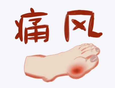 痛风患者饮食指南：避雷与优选清单全解析